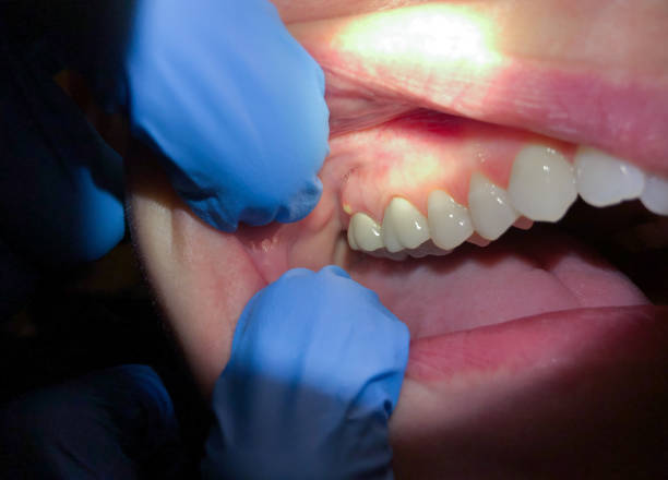 Best Chipped Tooth Repair Near Me  in North Laurel, MD